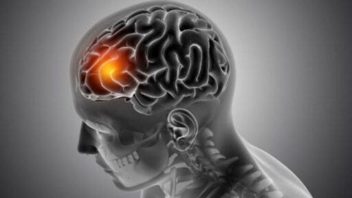 Perbedaan Stroke Ringan vs Stroke Berat Menurut Dokter dan Cara Penceahannya yang Tepat