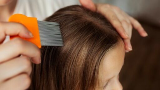 7 Cara Efektif dan Cepat Mengatasi Kutu Rambut Beserta Telurnya, Simak Tipsnya!