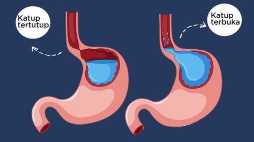 GERD Tak Kunjung Sembuh: Apakah Laparaskopi Menjadi Solusi Terbaik?