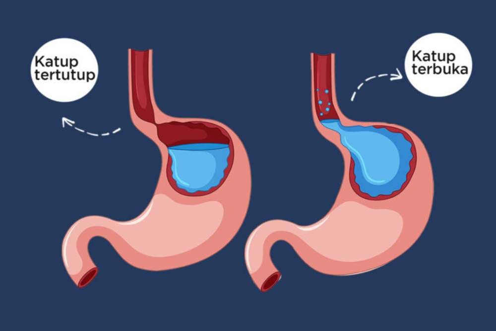 GERD Tak Kunjung Sembuh: Apakah Laparaskopi Menjadi Solusi Terbaik?