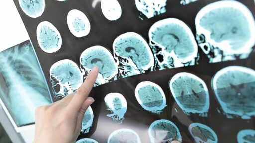 Teknologi MRI Makin Berkembang Berkat Dukungan AI, Diagnosis Medis Lebih Akurat