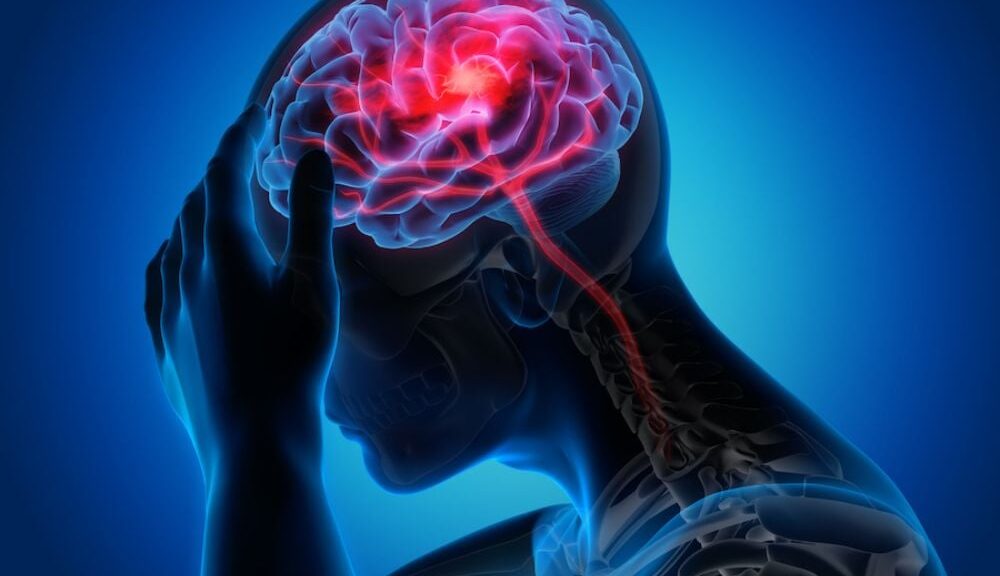 Ini Golongan Darah yang Paling Berisiko Kena Stroke: Temuan Penting untuk Kesehatan Anda